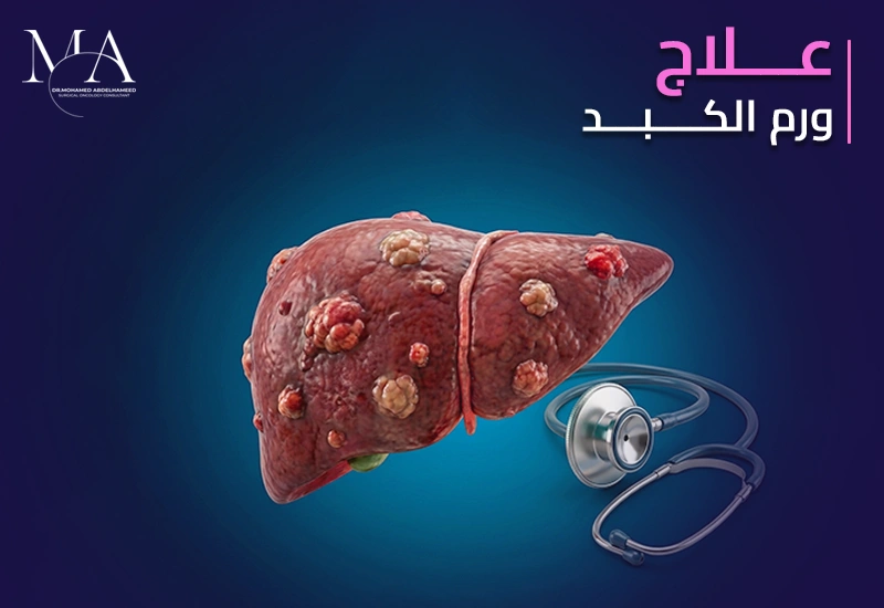 علاج ورم الكبد