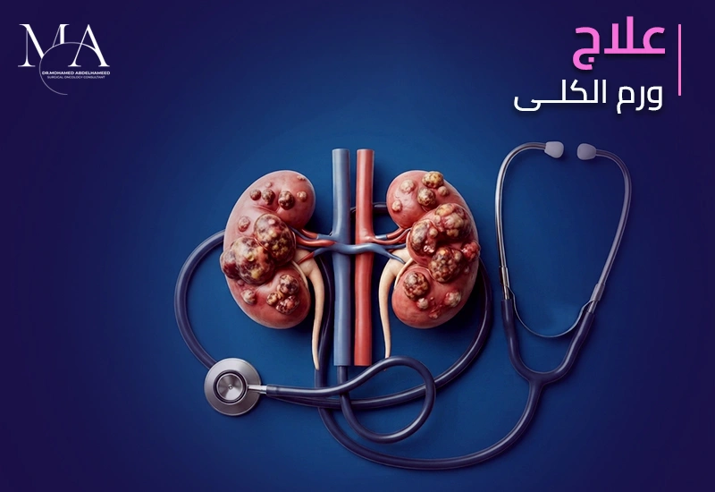 طرق علاج ورم الكلى الحميد والخبيث