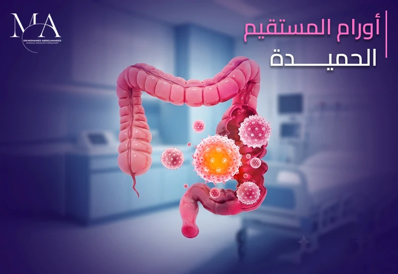 اورام المستقيم الحميدة: أنواعها وأسبابها وأعراضها