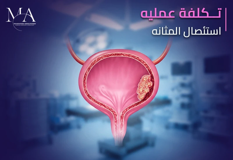 تكلفة عملية استئصال المثانة