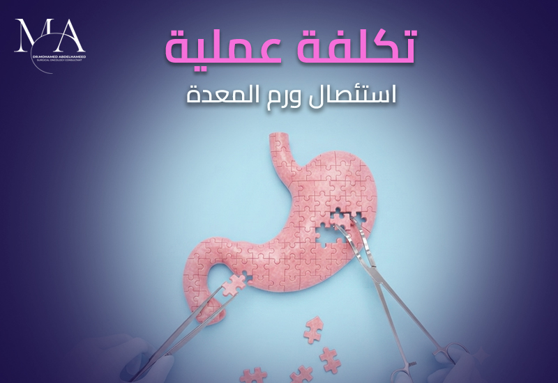 تكلفة عملية استئصال ورم المعدة – د.محمد عبد الحميد