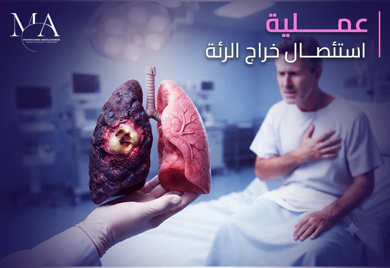 ما هي عملية استئصال خراج الرئة وكيف تتم؟