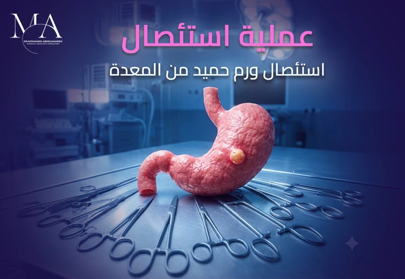 عملية استئصال ورم حميد من المعدة