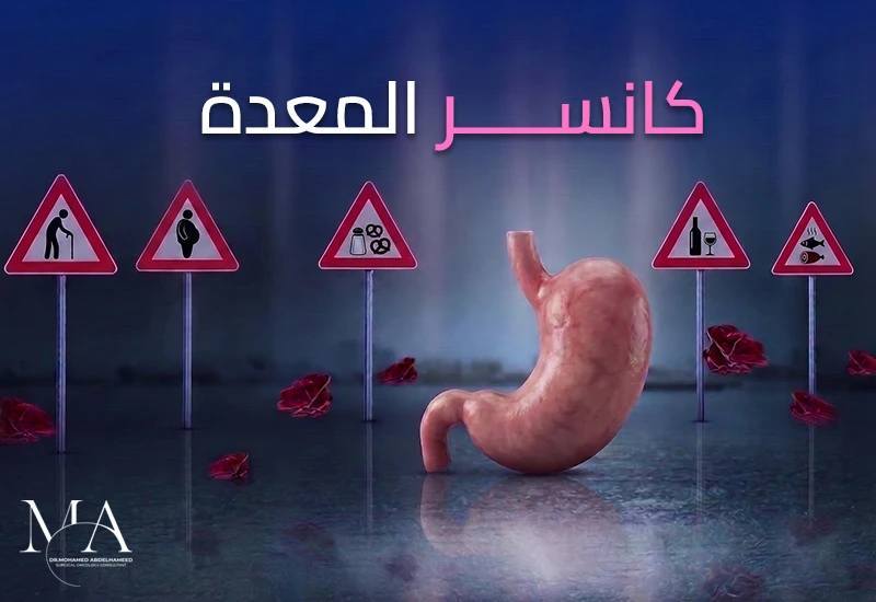 كانسر المعدة: الأعراض والأسباب وكيفية التشخيص