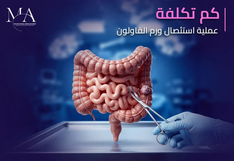 كم تكلفة عملية استئصال ورم القولون في مصر؟