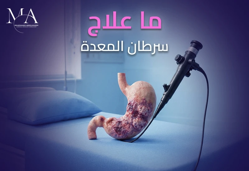 ما علاج سرطان المعدة وأحدث التقنيات؟ – د. محمد عبد الحميد
