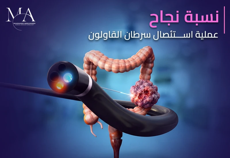 نسبة نجاح عملية استئصال سرطان القولون