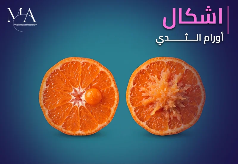 اشكال اورام الثدى