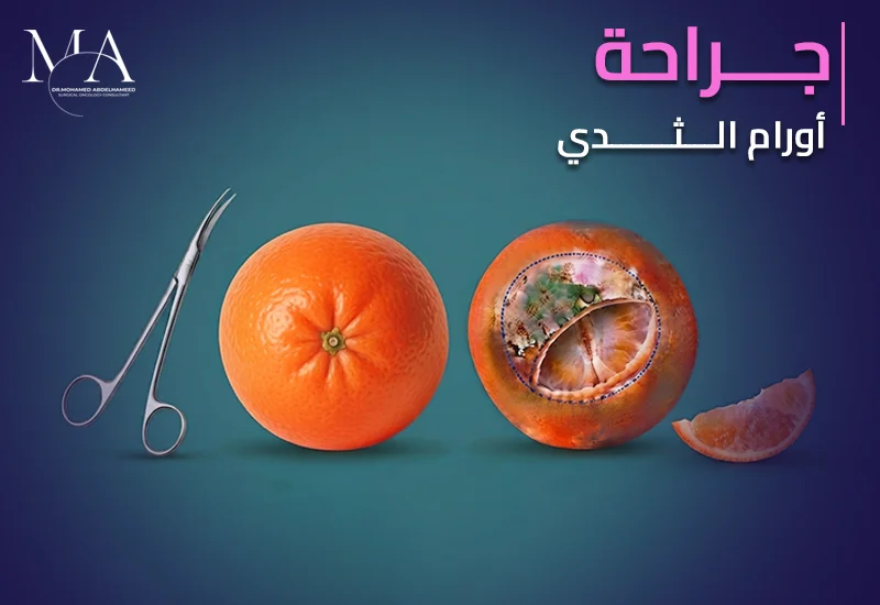 جراحة اورام الثدى
