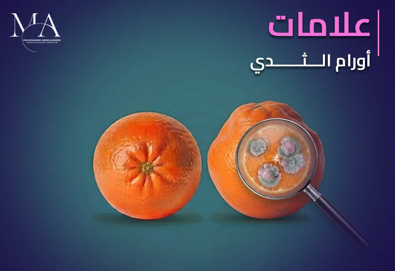 علامات اورام الثدى